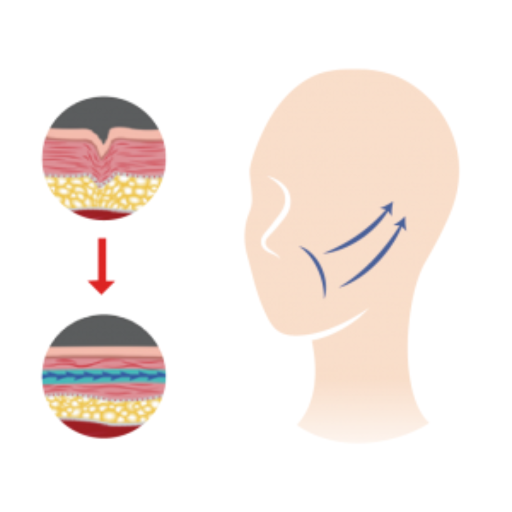 [Contour Lift] Pressed Cog l